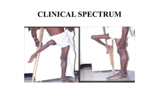 CLINICAL SPECTRUM
 