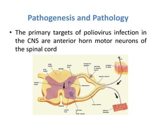 • The primary targets of poliovirus infection in
the CNS are anterior horn motor neurons of
the spinal cord
Pathogenesis and Pathology
 