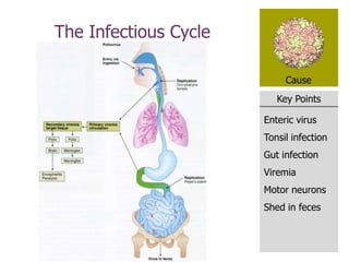 Key Points
Cause
The Infectious Cycle
Enteric virus
Tonsil infection
Gut infection
Viremia
Motor neurons
Shed in feces
 