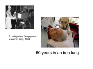 A polio patient being placed
in an iron lung, 1938.




                          60 years in an iron lung
 