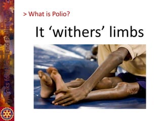 > What is Polio?

    It ‘withers’ limbs
 