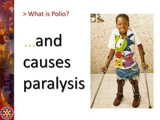 > What is Polio?



…and
causes
paralysis
 