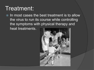 Treatment:
 In most cases the best treatment is to allow
the virus to run its course while controlling
the symptoms with physical therapy and
heat treatments.
 