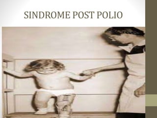 SINDROME POST POLIO
 