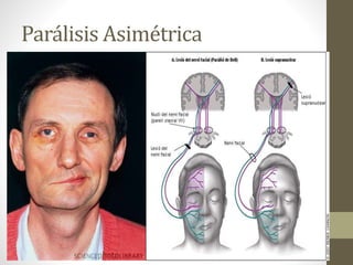 Parálisis Asimétrica
 