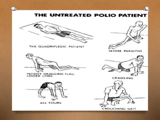 Polio virus