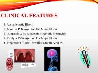 CLINICAL FEATURES
1. Asymptomatic Illness
2. Abortive Poliomyelitis: The Minor Illness
3. Nonparalytic Poliomyelitis or Aseptic Meningitis
4. Paralytic Poliomyelitis: The Major Illness
5. Progressive Postpoliomyelitis Muscle Atrophy
 