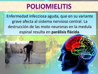 Enfermedad infecciosa aguda, que en su variante
grave afecta al sistema nervioso central. La
destrucción de las moto neuronas en la medula
espinal resulta en parálisis flácida.
3
 