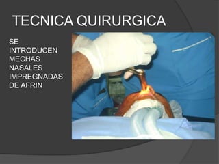 TECNICA QUIRURGICA
SE
INTRODUCEN
MECHAS
NASALES
IMPREGNADAS
DE AFRIN
 