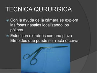 TECNICA QURURGICA
 Con la ayuda de la cámara se explora
las fosas nasales localizando los
pólipos.
 Estos son extraídos con una pinza
Etmoides que puede ser recta o curva.
 