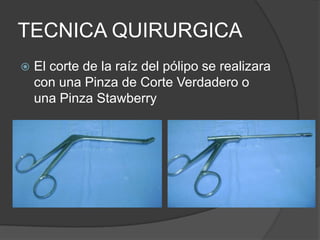 TECNICA QUIRURGICA
 El corte de la raíz del pólipo se realizara
con una Pinza de Corte Verdadero o
una Pinza Stawberry
 
