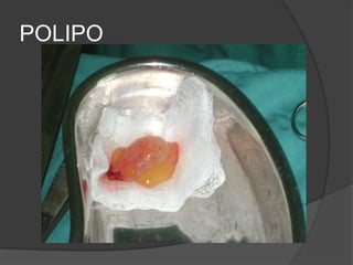 POLIPO
 