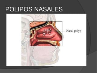 POLIPOS NASALES
 
