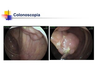 Colonoscopia
 