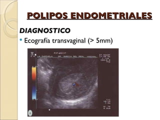 POLIPOS ENDOMETRIALES DIAGNOSTICO Ecografía transvaginal (> 5mm)  