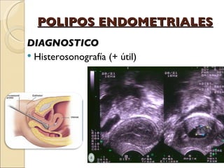 POLIPOS ENDOMETRIALES DIAGNOSTICO Histerosonografía (+ útil)  
