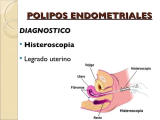 POLIPOS ENDOMETRIALES DIAGNOSTICO Histeroscopia Legrado uterino 