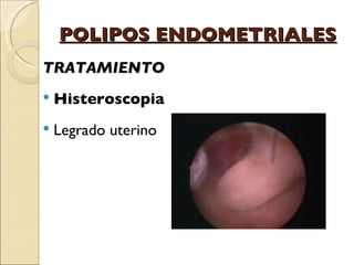 POLIPOS ENDOMETRIALES TRATAMIENTO Histeroscopia Legrado uterino 