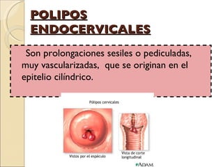 POLIPOS ENDOCERVICALES Son prolongaciones sesiles o pediculadas, muy vascularizadas,  que se originan en el epitelio cilíndrico. 