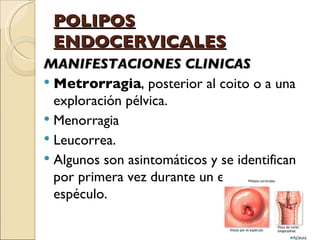 POLIPOS ENDOCERVICALES MANIFESTACIONES CLINICAS Metrorragia , posterior al coito o a una exploración pélvica. Menorragia Leucorrea. Algunos son asintomáticos y se identifican por primera vez durante un examen con espéculo. 