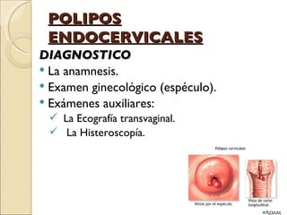 POLIPOS ENDOCERVICALES DIAGNOSTICO La anamnesis. Examen ginecológico (espéculo). Exámenes auxiliares: La Ecografía transvaginal. La Histeroscopía. 