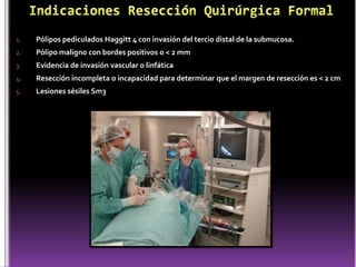 1. Pólipos pediculados Haggitt 4 con invasión del tercio distal de la submucosa.
2. Pólipo maligno con bordes positivos o < 2 mm
3. Evidencia de invasión vascular o linfática
4. Resección incompleta o incapacidad para determinar que el margen de resección es < 2 cm
5. Lesiones sésiles Sm3
 