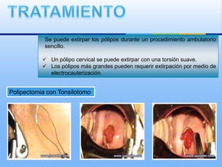 Se puede extirpar los pólipos durante un procedimiento ambulatorio
            sencillo.

            Un pólipo cervical se puede extirpar con una torsión suave.
            Los pólipos más grandes pueden requerir extirpación por medio de
             electrocauterización.


Polipectomia con Tonsilotomo
 