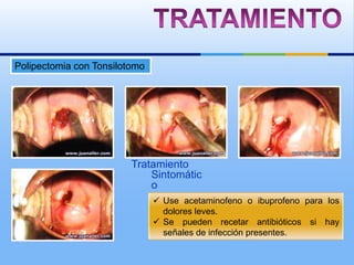 Polipectomia con Tonsilotomo




                         Tratamiento
                             Sintomátic
                             o
                                Use acetaminofeno o ibuprofeno para los
                                 dolores leves.
                                Se pueden recetar antibióticos si hay
                                 señales de infección presentes.
 