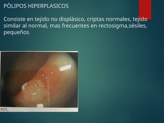PÒLIPOS HIPERPLASICOS
Consiste en tejido no displàsico, criptas normales, tejido
similar al normal, mas frecuentes en rectosigma,sésiles,
pequeños
 