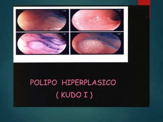 POLIPO HIPERPLASICO
( KUDO I )
 