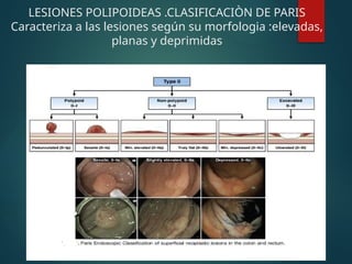 LESIONES POLIPOIDEAS .CLASIFICACIÒN DE PARIS
Caracteriza a las lesiones según su morfologia :elevadas,
planas y deprimidas
 