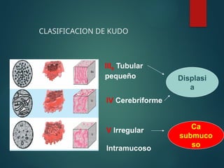 CLASIFICACION DE KUDO
IIIS Tubular
pequeño
IV Cerebriforme
V Irregular
Intramucoso
Displasi
a
Ca
submuco
so
 