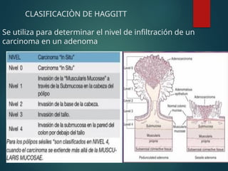 CLASIFICACIÒN DE HAGGITT
Se utiliza para determinar el nivel de infiltración de un
carcinoma en un adenoma
 