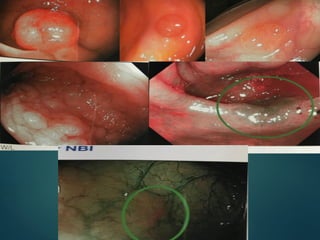 POLIPOS COLONICOS.......................