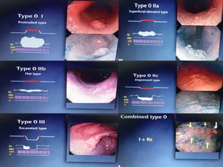 POLIPOS COLONICOS.......................