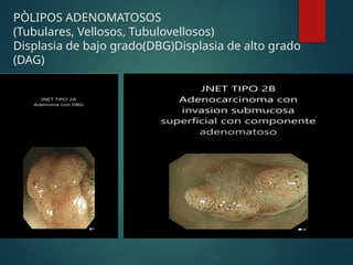 PÒLIPOS ADENOMATOSOS
(Tubulares, Vellosos, Tubulovellosos)
Displasia de bajo grado(DBG)Displasia de alto grado
(DAG)
 