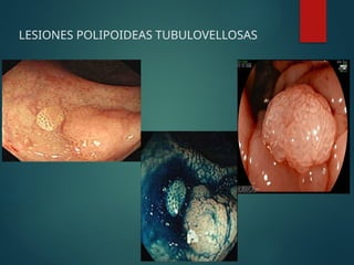LESIONES POLIPOIDEAS TUBULOVELLOSAS
 