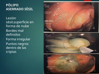 PÒLIPO
ASERRADO SÈSIL
Lesiòn
sésil,superficie en
forma de nube
Bordes mal
definidos
Forma irregular
Puntos negros
dentro de las
criptas
 