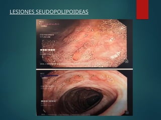 LESIONES SEUDOPOLIPOIDEAS
 