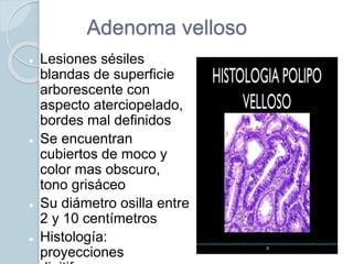 Adenoma velloso
 Lesiones sésiles
blandas de superficie
arborescente con
aspecto aterciopelado,
bordes mal definidos
 Se encuentran
cubiertos de moco y
color mas obscuro,
tono grisáceo
 Su diámetro osilla entre
2 y 10 centímetros
 Histología:
proyecciones
 