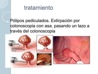 tratamiento
 Pólipos pediculados. Extirpación por
colonoscopia con asa. pasando un lazo a
través del colonoscopia
 
