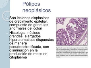 Pólipos
neoplásicos
 Son lesiones displasicas
de crecimiento epitelial,
compuesto de gandulas
anormales del colon
 Histologia: núcleos
grandes, alargados
hipercromaticos dispuestos
de manera
pseudoestratificada, con
disminución en la
producción de moco en
citoplasma
 