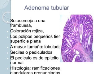 Adenoma tubular
 Se asemeja a una
frambuesa,
 Coloración rojiza,
 Los polipos pequeños tiene
superficie plana
 A mayor tamaño: lobulado
 Seciles o pediculados
 El pediculo es de epitelio
normal
 Histología: ramificaciones
 
