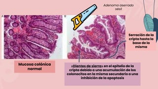 «Dientes de sierra» en el epitelio de la
cripta debido a una acumulación de los
colonocitos en la misma secundario a una
inhibición de la apoptosis
Serración de la
cripta hasta la
base de la
misma
Mucosa colónica
normal
Adenoma aserrado
sésil
 