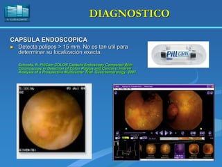 H. “LLUÍS ALCANYÍS”
DIAGNOSTICO
CAPSULA ENDOSCOPICA
 Detecta pólipos > 15 mm. No es tan útil para
determinar su localización exacta.
Schoofs, N. PillCam COLON Capsule Endoscopy Compared With
Colonoscopy in Detection of Colon Polyps and Cancers: Interim
Analysis of a Prospective Multicenter Trial. Gastroenterology, 2007.
 