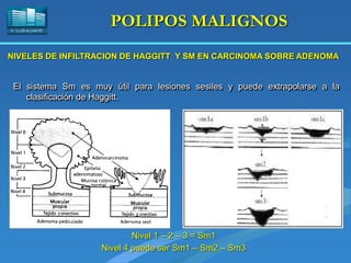 H. “LLUÍS ALCANYÍS”
POLIPOS MALIGNOS
El sistema Sm es muy útil para lesiones sesiles y puede extrapolarse a la
clasificación de Haggitt.
Nivel 1 – 2 – 3 = Sm1
Nivel 4 puede ser Sm1 – Sm2 – Sm3
NIVELES DE INFILTRACION DE HAGGITT Y SM EN CARCINOMA SOBRE ADENOMA
 