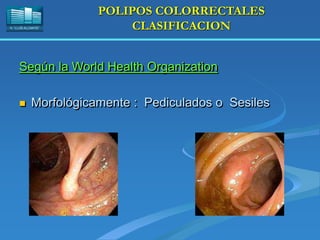H. “LLUÍS ALCANYÍS”
POLIPOS COLORRECTALES
CLASIFICACION
Según la World Health Organization
 Morfológicamente : Pediculados o Sesiles
 