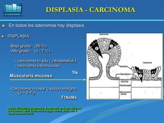 H. “LLUÍS ALCANYÍS”
DISPLASIA - CARCINOMA
 DISPLASIA
-Bajo grado (90 %)
-Alto grado (5 - 7 %)
- carcinoma in situ ( intraepitelial )
- carcinoma intramucoso
Muscularis mucosa
-Carcinoma invasor o pólipo maligno
(3 – 5 %)
T1NxMx
Polyp Guideline: Diagnosis, Treatment, and surveillance
for Patients With Colorectal Polyps Bond, M.D., Am J
Gastroenterol 2000.
 En todos los adenomas hay displasia.
Tis
 