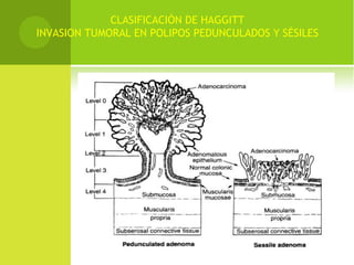 CLASIFICACIÓN DE HAGGITT
INVASION TUMORAL EN POLIPOS PEDUNCULADOS Y SÉSILES
 