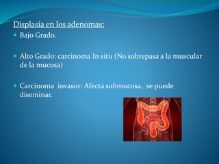 Displasia en los adenomas:
 Bajo Grado.
 Alto Grado: carcinoma In situ (No sobrepasa a la muscular
de la mucosa)
 Carcinoma invasor: Afecta submucosa, se puede
diseminar.
 
